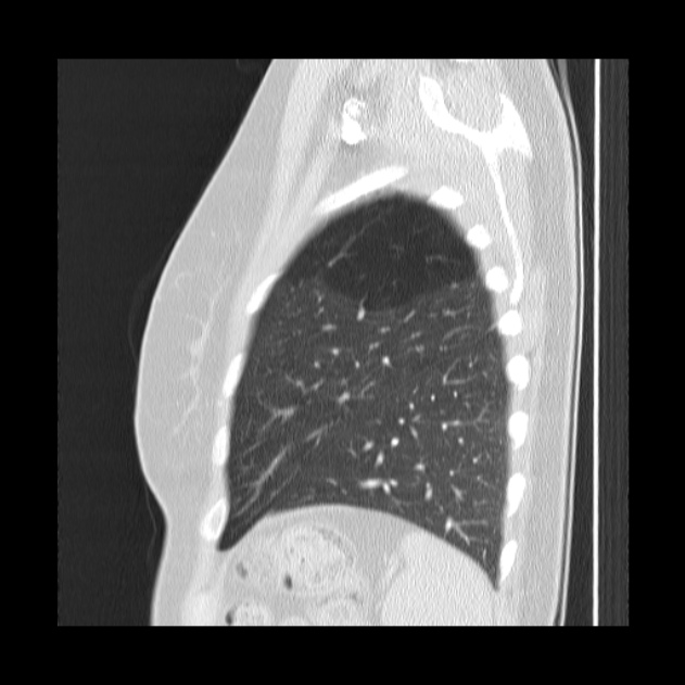 Bronchial atresia (Radiopaedia 22965-22992 Sagittal lung window 10).jpg