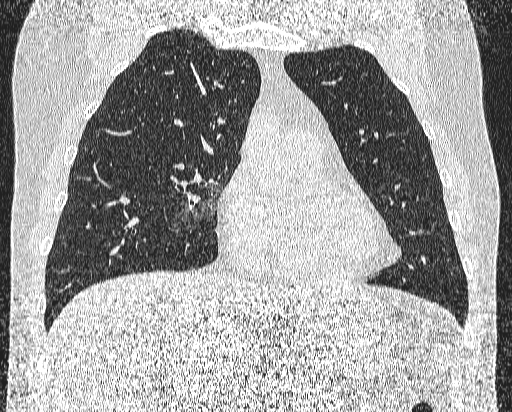 Bronchial atresia (Radiopaedia 58271-65417 Coronal lung window 18).jpg