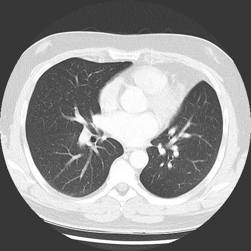 Bronchial carcinoid tumor (Radiopaedia 67377-76764 Axial lung window 35).jpg