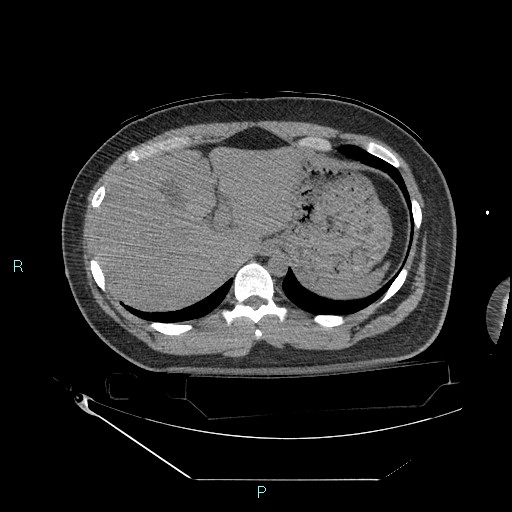 File:Bronchial carcinoid tumor (Radiopaedia 78272-90870 Axial non-contrast 97).jpg