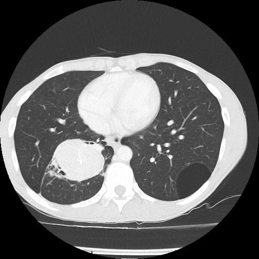 Bronchial carcinoid tumor causing right lower lobe collapse (Radiopaedia 83495-98594 Axial lung window 36).jpg