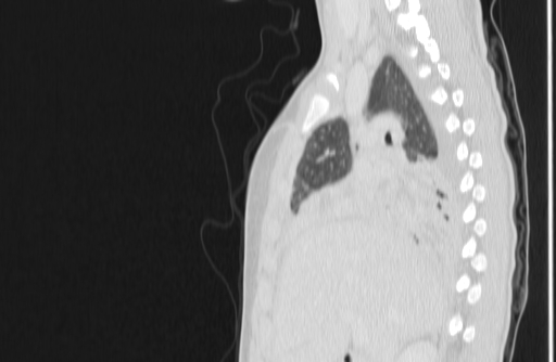 Bronchial mucoepidermoid carcinoma (Radiopaedia 57023-63895 Sagittal lung window 49).jpg