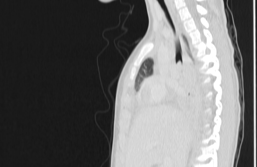 Bronchial mucoepidermoid carcinoma (Radiopaedia 57023-63895 Sagittal lung window 63).jpg