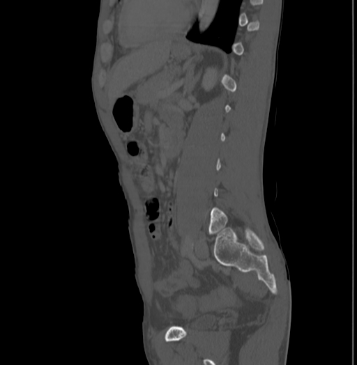 Bronchiectasis in Crohn disease (Radiopaedia 60311-67977 Sagittal bone window 162).jpg