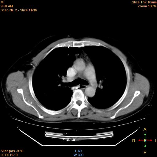 File:Bronchogenic carcinoma with superior vena caval invasion (Radiopaedia 22378-22406 Mediastinal window 9).jpg