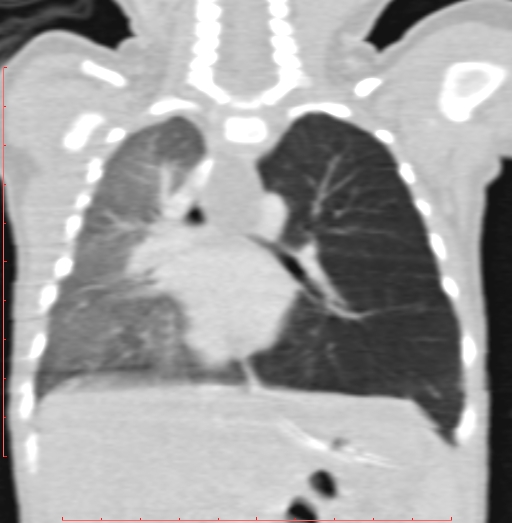 Bronchogenic cyst (Radiopaedia 78599-91409 Coronal lung window 131).jpg