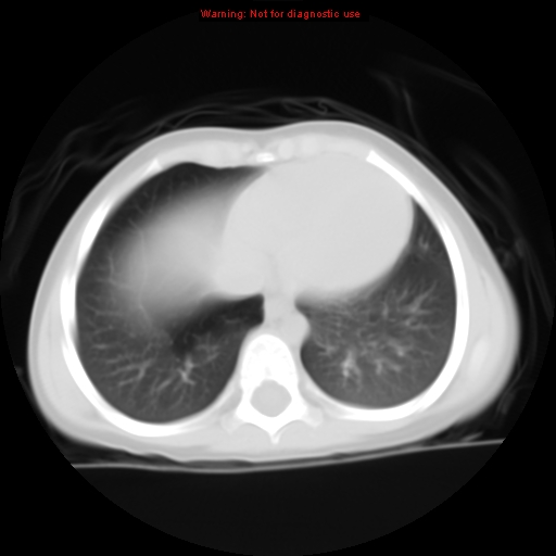 File:Bronchogenic cyst (Radiopaedia 9372-10063 Axial lung window 12).jpg