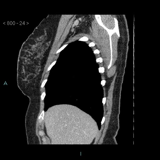 Bronchogenic cyst - posterior mediastinal (Radiopaedia 43885-47364 B 15).jpg