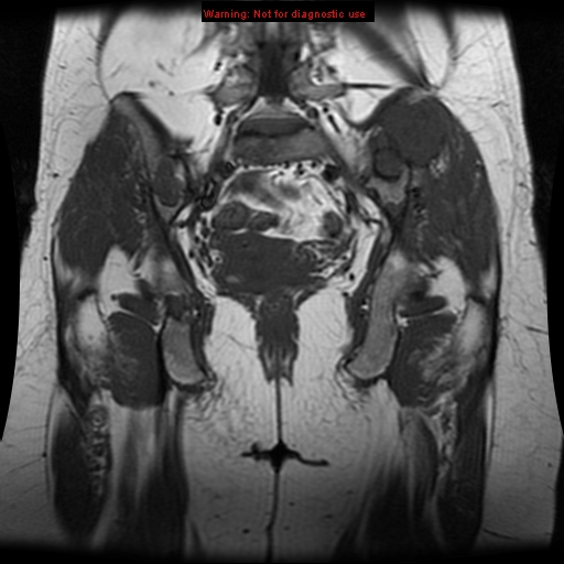 File:Brown tumors (Radiopaedia 9666-10290 Coronal T1 19).jpg