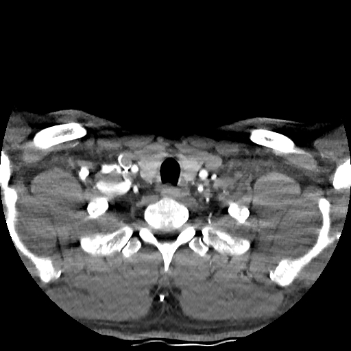 Buccal fat pad arteriovenous malformation (Radiopaedia 70936-81144 D 49).jpg