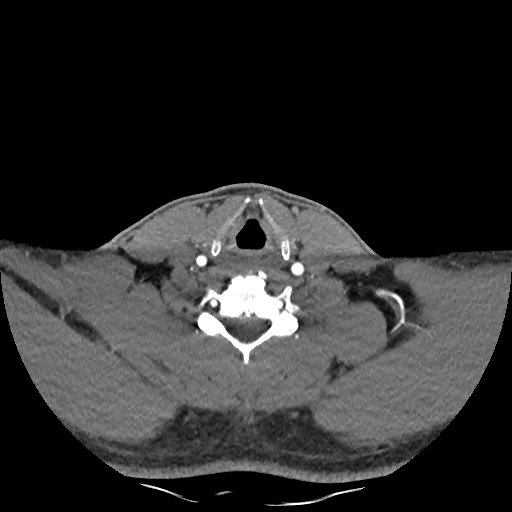 Buccal fat pad arteriovenous malformation (Radiopaedia 70936-81144 D 97).jpg