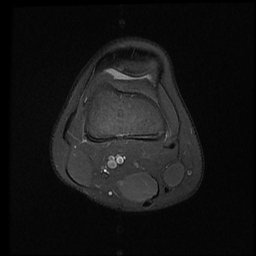 File:Bucket handle tear - lateral meniscus (Radiopaedia 72124-82634 Axial PD fat sat 1).jpg