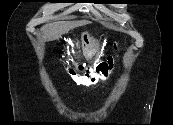 Buried bumper syndrome - gastrostomy tube (Radiopaedia 63843-72577 Coronal Inject 26).jpg
