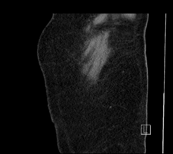 Buried bumper syndrome - gastrostomy tube (Radiopaedia 63843-72577 Sagittal Inject 118).jpg