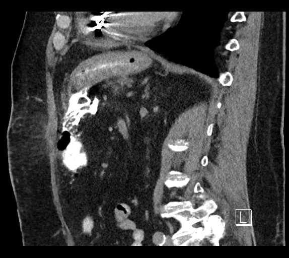 Buried bumper syndrome - gastrostomy tube (Radiopaedia 63843-72577 Sagittal Inject 48).jpg