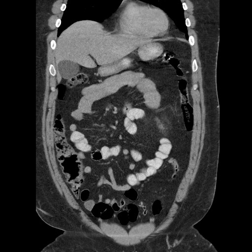 Burned-out testicular seminoma - retroperitoneal nodal metastases (Radiopaedia 62872-71245 B 22).jpg