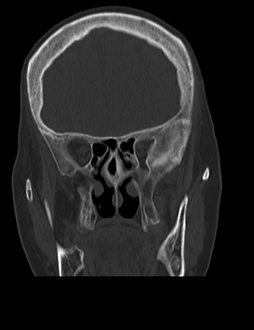 Burnt-out meningioma (Radiopaedia 51557-57337 Coronal bone window 15).jpg