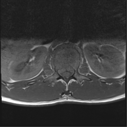 File:Burst fracture - T12 with conus compression (Radiopaedia 56825-63646 Axial T1 14).png