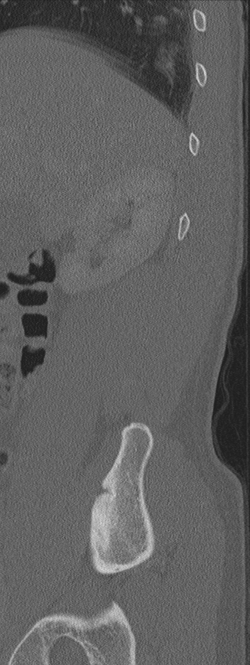 Burst fracture - T12 with conus compression (Radiopaedia 56825-63647 Sagittal bone window 82).png