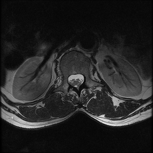 File:Burst fracture - lumbar spine (Radiopaedia 72877-83541 Axial T2 3).jpg