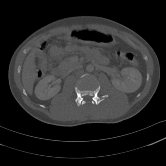 Burst fracture with cauda equina syndrome (Radiopaedia 25701-25867 Axial bone window 31).jpg