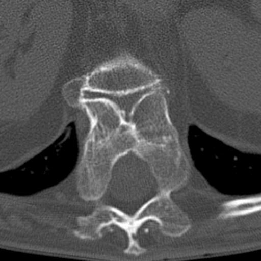 Butterfly vertebrae with kyphoscoliosis (Radiopaedia 14257-14133 Axial bone window 51).jpg