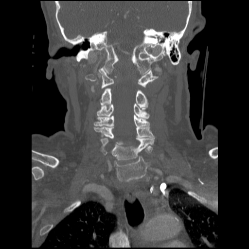 File:C1 anterior arch (plough) fracture - type 1 (Radiopaedia 76181-87720 Coronal bone window 49).jpg