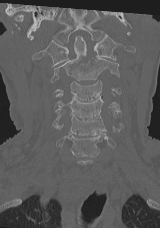 C2 fracture with vertebral artery dissection (Radiopaedia 37378-39199 Coronal bone window 14).png