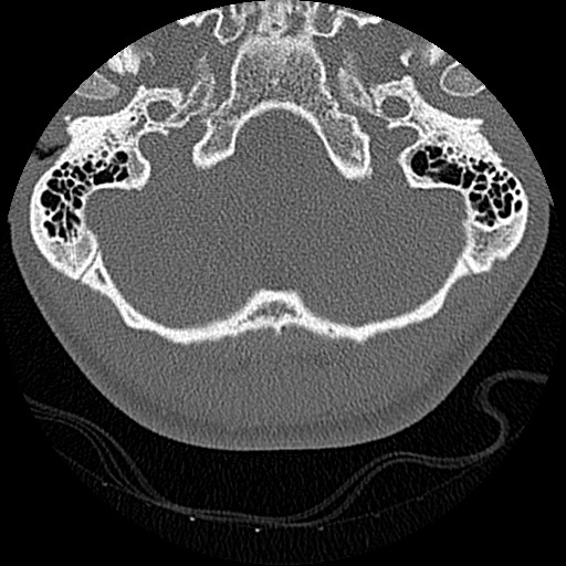 File:C5 facet fracture (Radiopaedia 58374-65499 Axial bone window 1).jpg