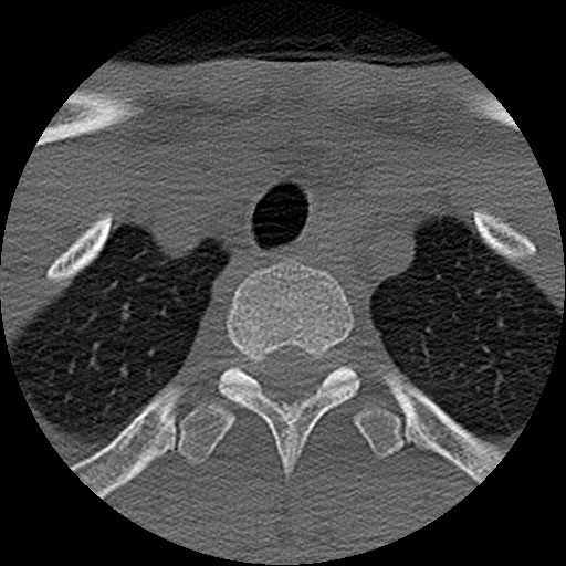 File:C5 facet fracture (Radiopaedia 58374-65499 Axial bone window 94).jpg