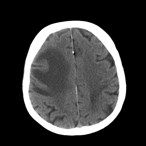 File:CNS lymphoma (Radiopaedia 36983-38639 Axial non-contrast 27).png