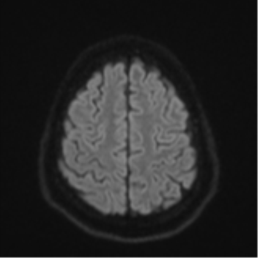 File:CNS vasculitis (Radiopaedia 55715-62263 Axial DWI 53).png