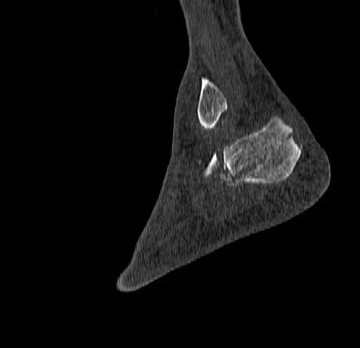Calcaneal fracture - Sanders type 4 (Radiopaedia 90179-107370 Sagittal bone window 72).jpg