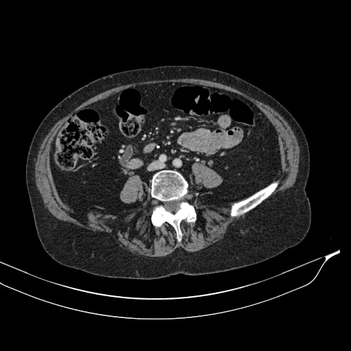 Calcified adrenal glands and Spigelian hernia (Radiopaedia 49741-54988 A 136).jpg