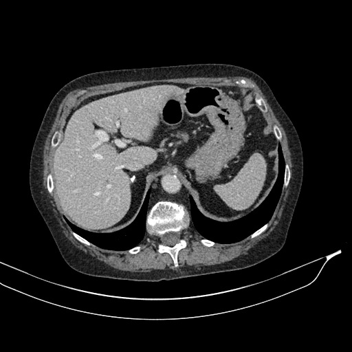 Calcified adrenal glands and Spigelian hernia (Radiopaedia 49741-54988 A 47).jpg