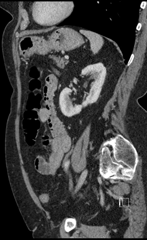 Calcified adrenal glands and Spigelian hernia (Radiopaedia 49741-54988 C 51).jpg