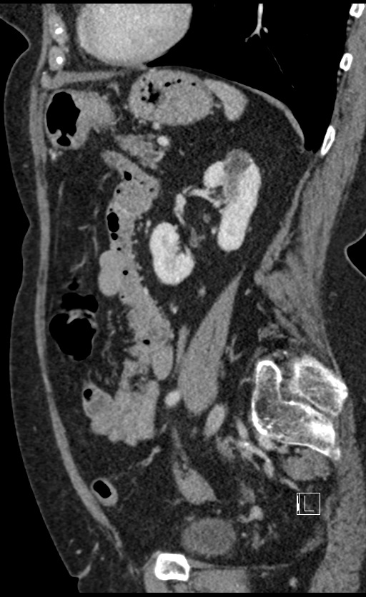 Calcified adrenal glands and Spigelian hernia (Radiopaedia 49741-54988 C 54).jpg