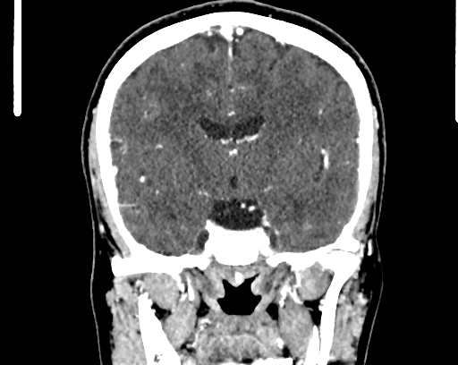 Calcified cerebral hydatid cyst (Radiopaedia 65603-74717 C 34).jpg