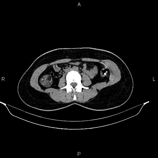 File:Calcified hepatic hydatid cyst (Radiopaedia 84672-100095 Axial non-contrast 62).jpg