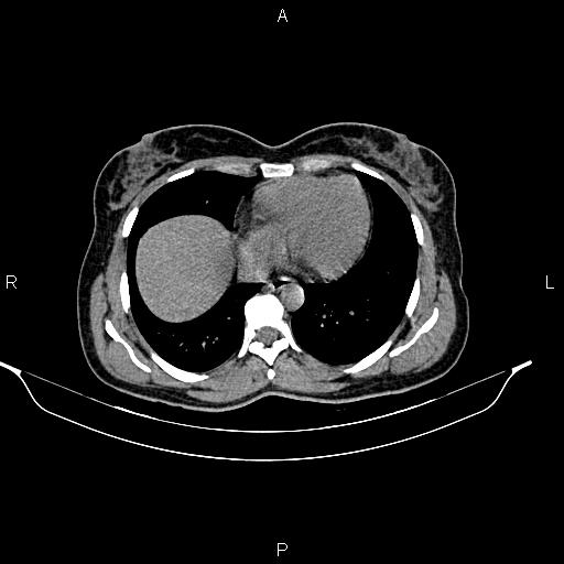 File:Calcified hepatic hydatid cyst (Radiopaedia 84672-100095 Axial non-contrast 9).jpg