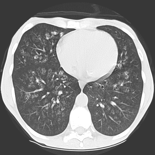 File:Calciphylaxis and metastatic pulmonary calcification (Radiopaedia 10887-11317 Axial lung window 31).jpg