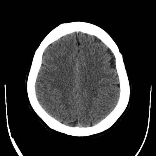 File:Calvarial osteoma (Radiopaedia 36520-38079 Axial non-contrast 41).jpg