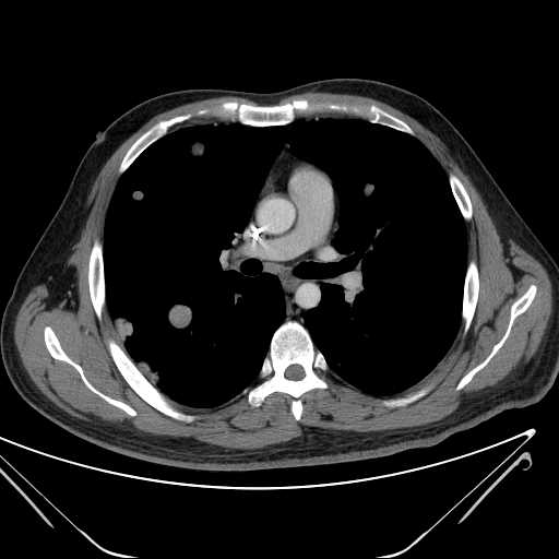 File:Cannonball pulmonary metastases (Radiopaedia 67684-77101 D 127).jpg