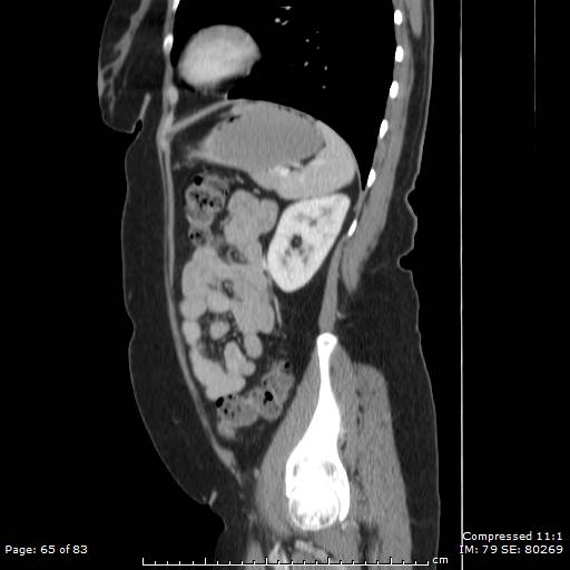 Carcinoid syndrome (Radiopaedia 52706-58626 C 43).jpg