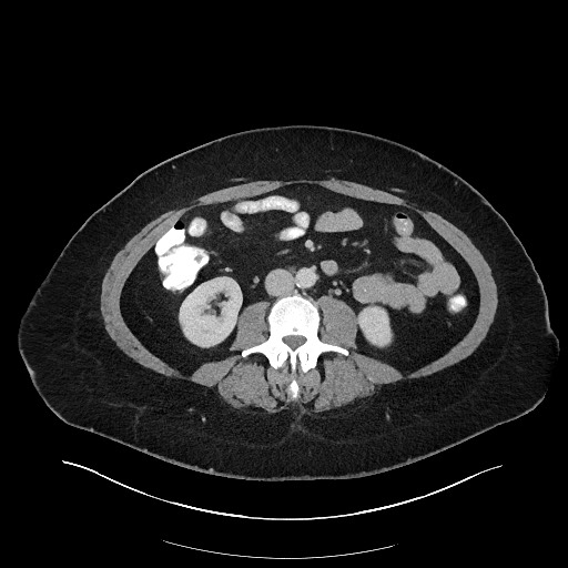 File:Carcinoid tumor - terminal ileum (Radiopaedia 60931-68739 A 70).jpg