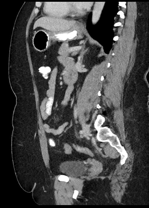 Carcinoid tumor - terminal ileum (Radiopaedia 60931-68739 C 38).jpg