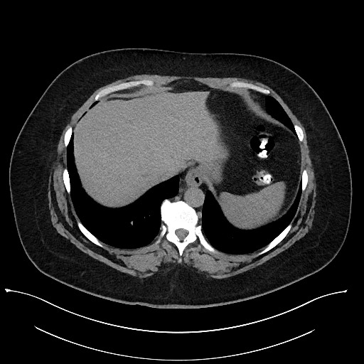 Carcinoid tumor - terminal ileum (Radiopaedia 60931-68740 Axial non-contrast 8).jpg