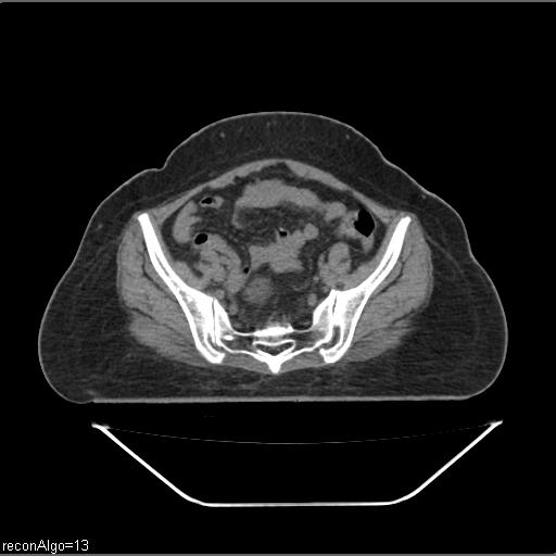 Carcinoma cervix- brachytherapy applicator (Radiopaedia 33135-34173 Axial non-contrast 14).jpg