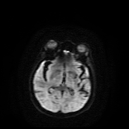Carcinoma ex-pleomorphic adenoma of parotid (Radiopaedia 28383-28627 Ax DWI B-500 GE 72).jpg