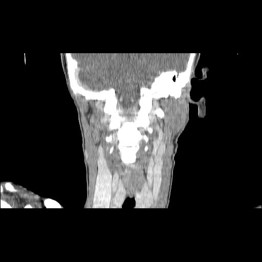 Carcinoma of the maxillary antrum (Radiopaedia 53805-59888 Coronal C+ delayed 110).jpg